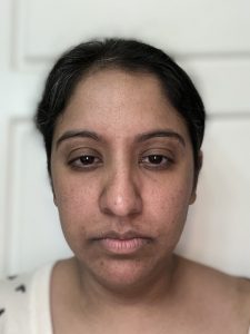 After Gabellar neurotoxin administration