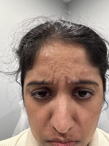 Before Gabellar neurotoxin administration